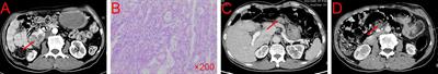 Preliminary response to Tislelizumab plus chemotherapy drugs in patient with periampullary carcinoma: a report of one case and a literature review